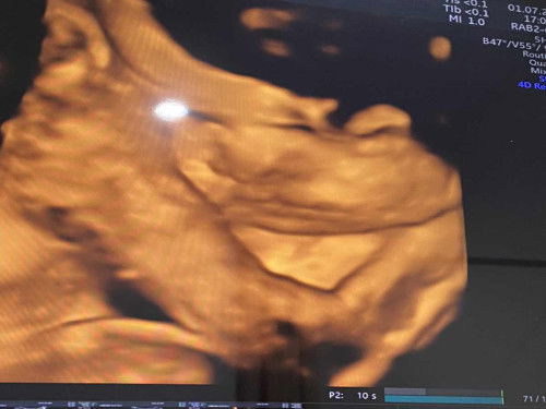 ปากแหว่งเพดานโหว่