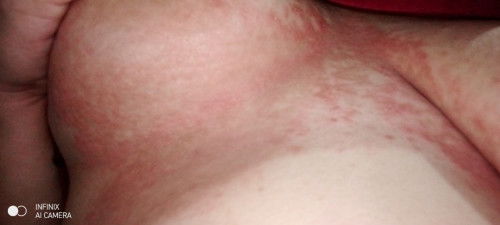 Rashes during pregnancy