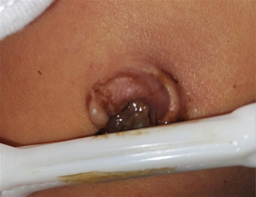 Umbilical cord
