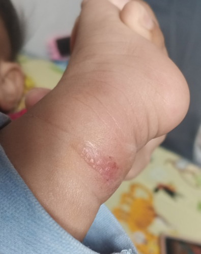 skin rash.