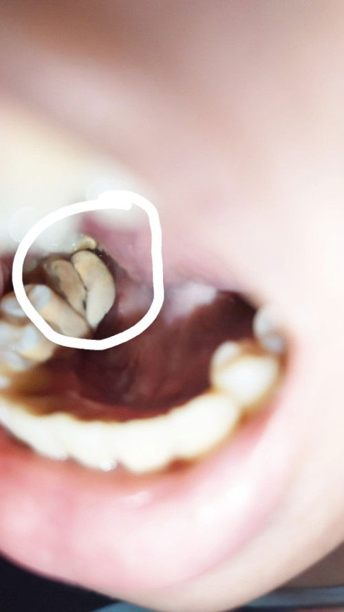 Pamamaga ng pisngi dahil sa ipin