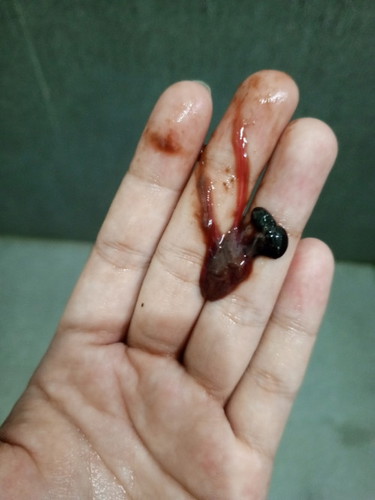 After IE? Normal poba?