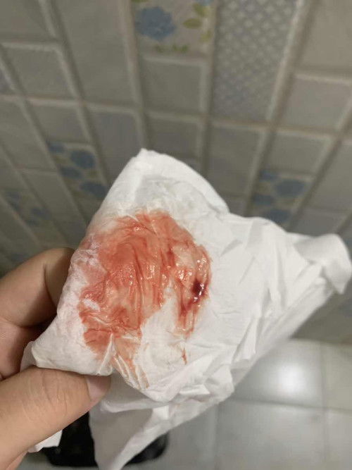 แม่ๆปากมดลูกเปิด1เซน