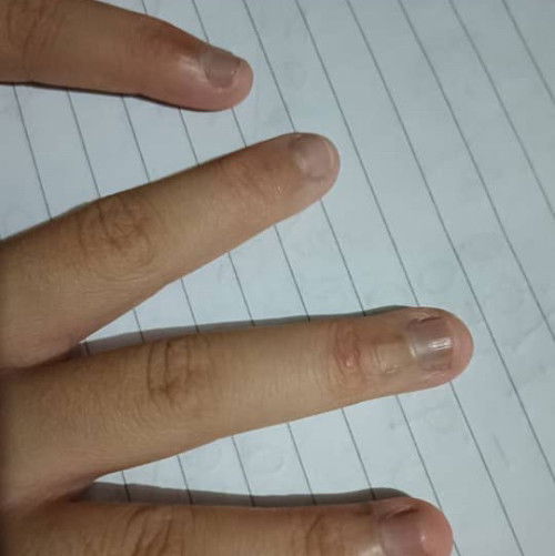 Apa penyebab kuku jadi gelap?