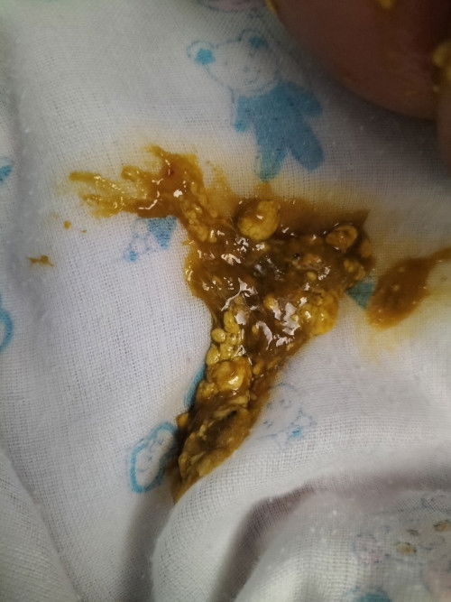 อึลูกสีเหลืองแต่เป็นเมือกๆ