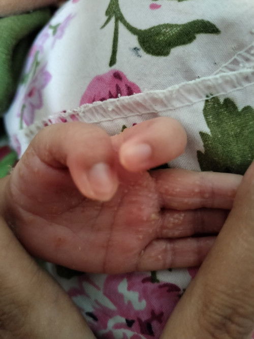 Tangan bayi bentol berair