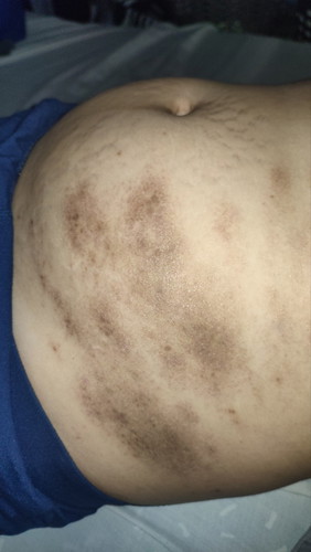 PUPPP rash sa 2nd Trimester