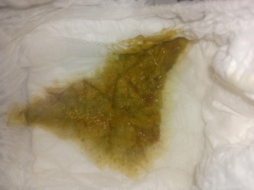 แบบนี้ถ่ายปกติไหม