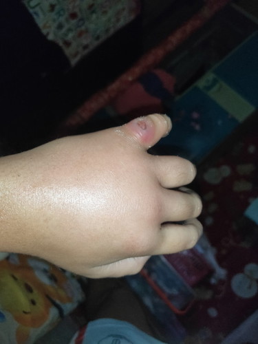Pwede po ba uminom ang buntis ng amoxicillin?Sobrang sakit na kase ng pigsa ko at namamaga