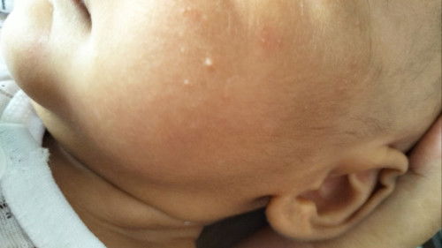 Ruam muka bayi newborn