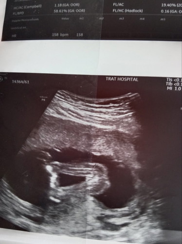 เพศลูก17วีค2วัน
