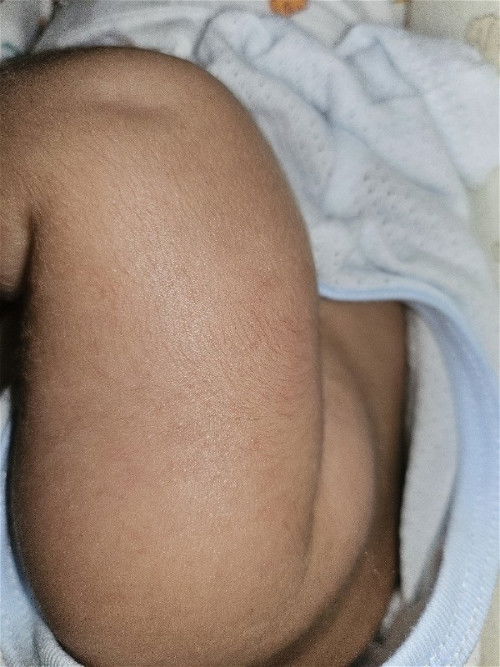 แบบนี้เรียกผดร้อนหรือน้องแพ้อะไรรึป่าวคะ