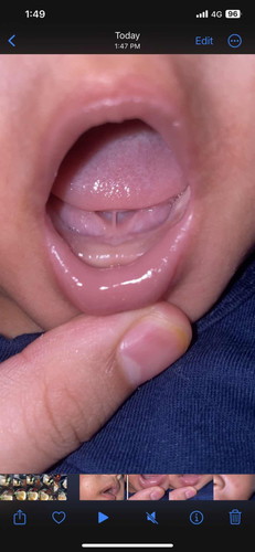Tounge tie / lidah pendek