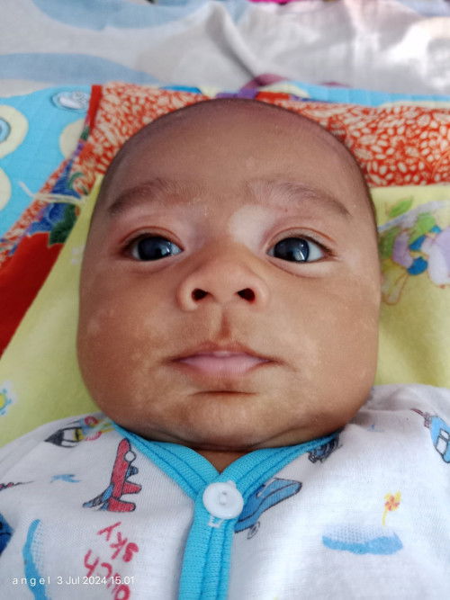 Bercak putih pada wajah