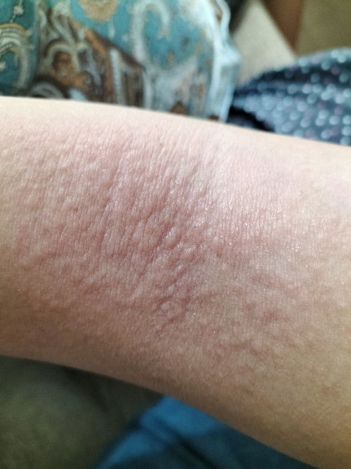 Hamil 29 week alergi gatal2,ada yang sama gak bun seperti saya???