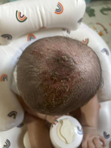 Need help for baby rash
