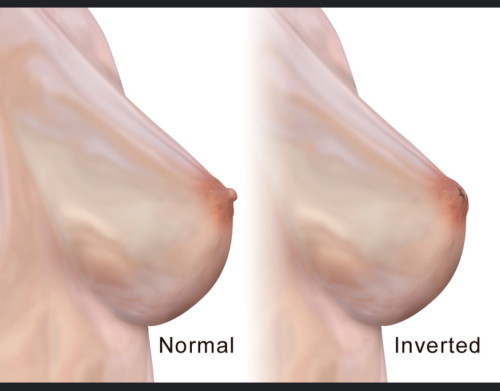 Tips for inverted nipple