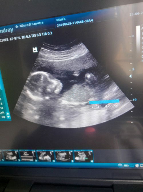 Masih sering nyeri pdhl udh 5bln..
#shering_dong_bunda