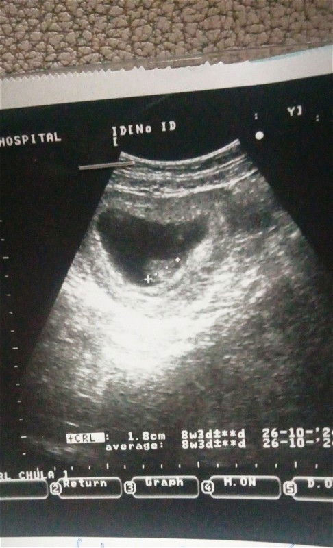 แม่ๆคะพอดีเราประจำเดือนขาด1เดือนมารอบสุดท้ายคือ19เมษาแล้วก็ไม่มาอีกเลยพอวันที่2 มิถุนาตรวจขึ้นสองขีด