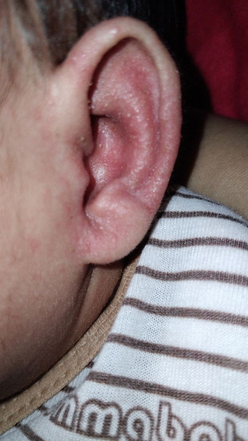 Iritasi atau alergi?