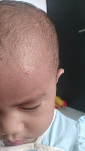 Bekas luka pada anak