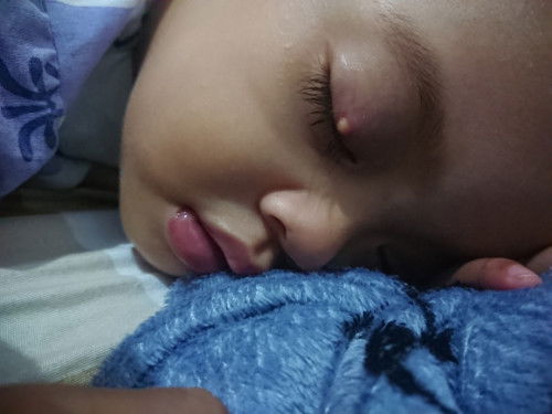 Bisul di mata pada anak, apa obatnya?