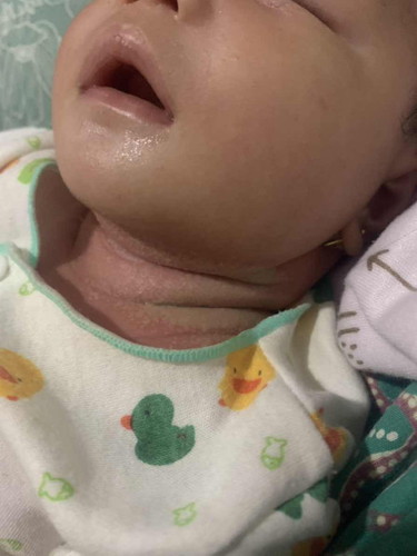 Kenapa ya bun anak aku lehernya ruam kya ada nanahnya gtu
