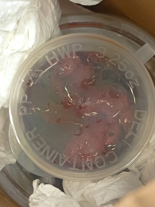 Keguguran Kali kedua