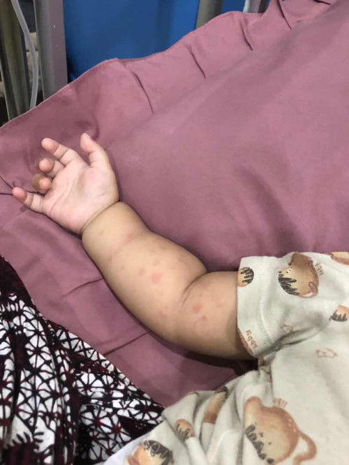 Bentol2 merah seluruh badan