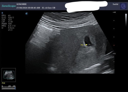 First Trimester