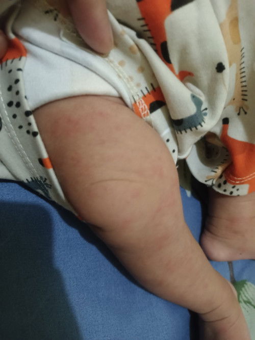 Timbul bintik merah padq bayi