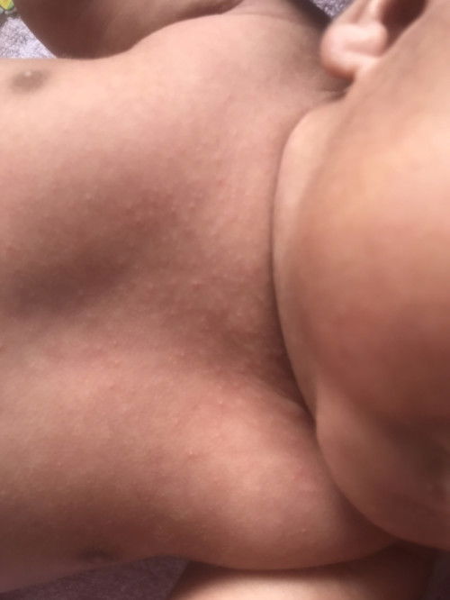 ผื่นแบบนี้น้องแพ้อะไรคะน้องทานนมผงคะ