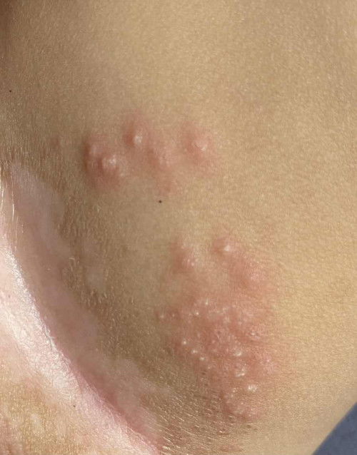 น้องเป็นผื่นอะไรค่ะ