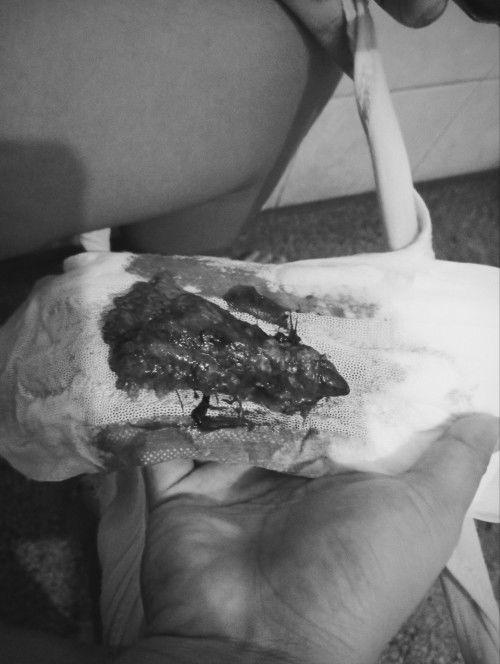 Complete miscarriage diagnosis Blighted ovum 6weeks na sana sya kaso gestational sac plang nakita