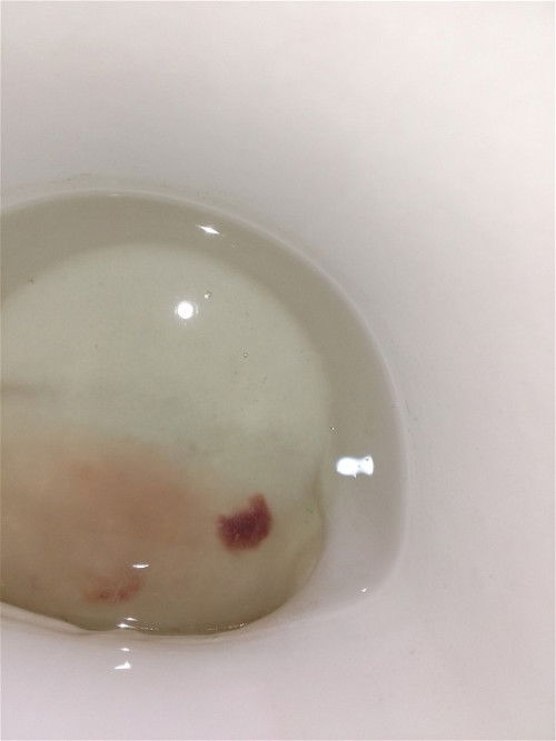 Blood clot. EDD @ July 27