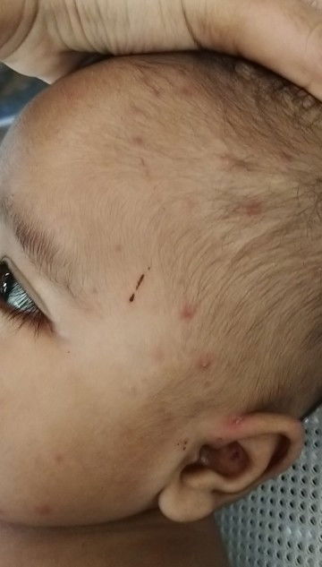 Knpe dengan kulit anak saya