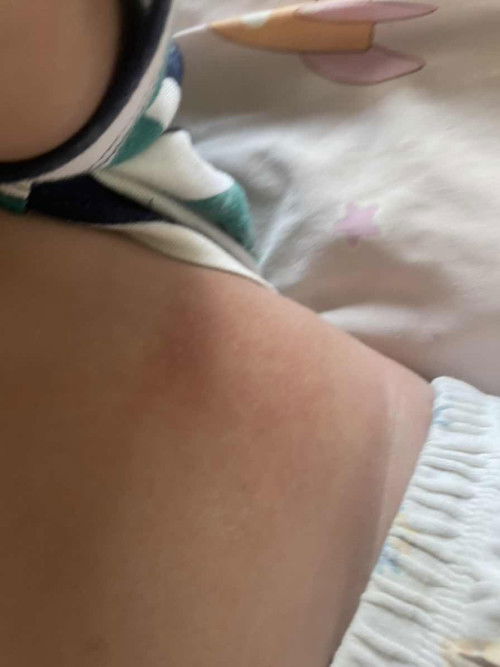 น้องเป็นผื่นแดง