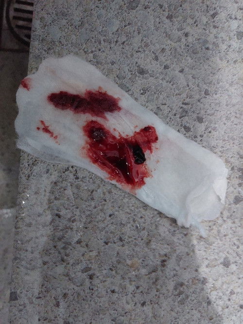 ngeflek dan smpai keluar darah (usia 6week blm ada janin)