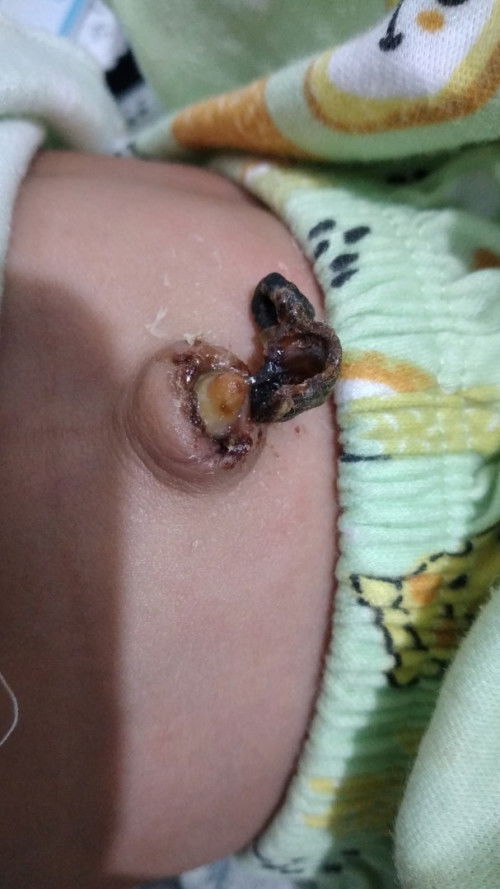 Pusar tumbuh granuloma umbilikalis