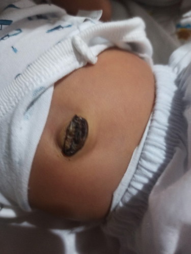 ask lang po ako turning 1 month na si LO ko sa 11, pero yung pusod nya hindi parin natatanggal.