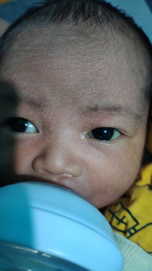 Ruam putih di wajah Newborn