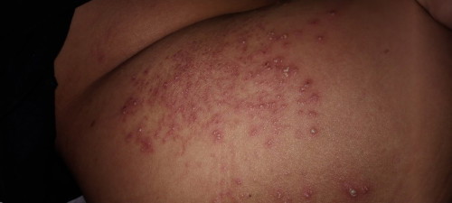 Bintik merah dan gatal