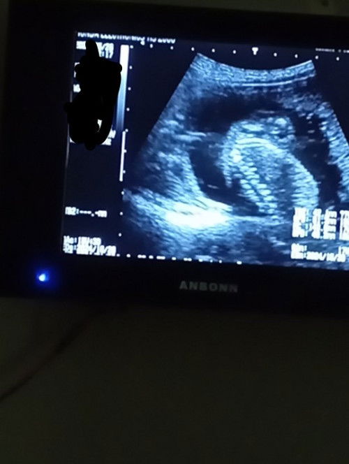 18weeks pelvic ultrasound