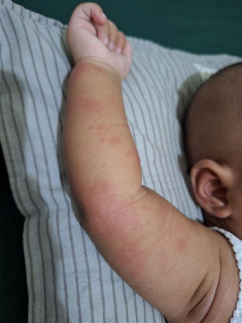 Timbul ruam merah setelah demam