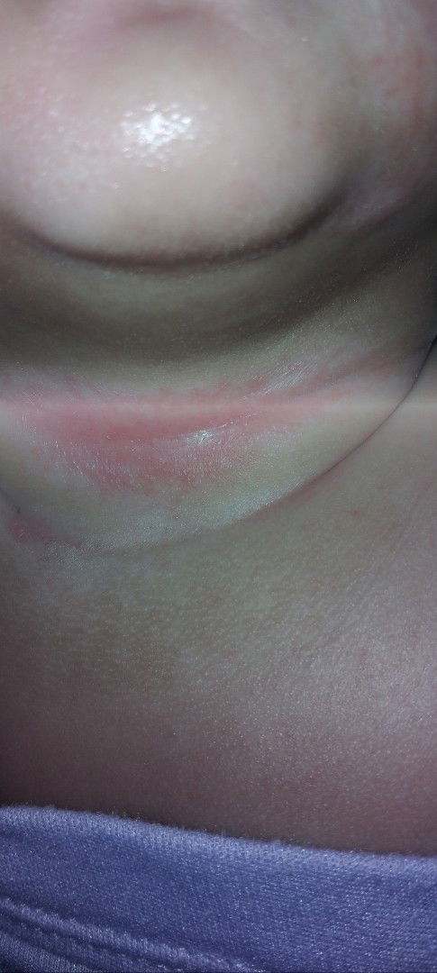 Merah merah pada leher bayi