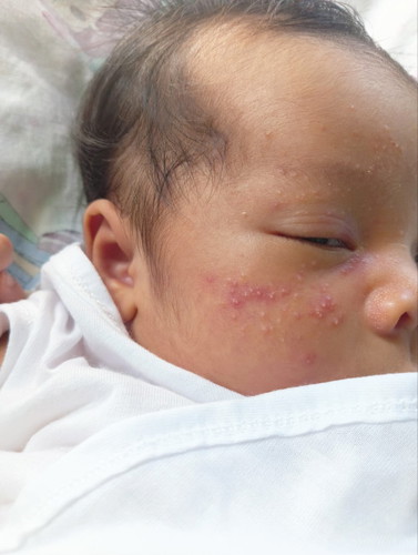 Baby acne