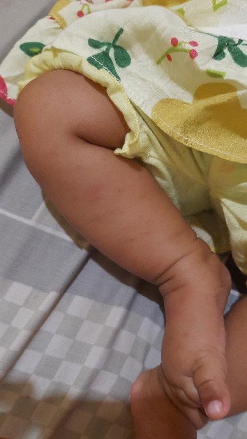 Menghilangkan bekas gigitan nyamuk