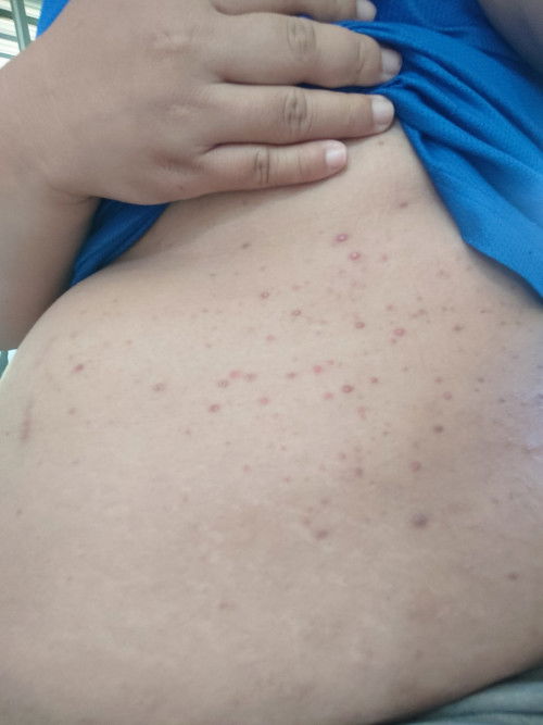 33วีค มีตุ่มผื่นขึ้นแบบนี้