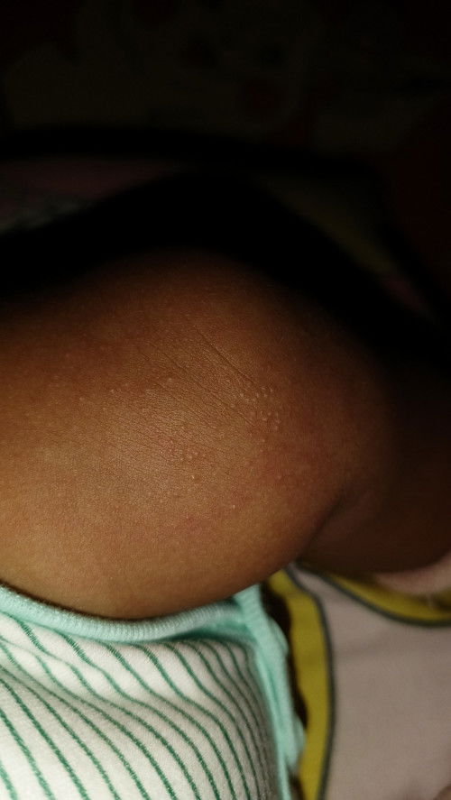 Bun mau tanya, anak saya ada bintik² kaya gini. Diperhatikan mkn byk, ini kenapa yah? Solusinya bun