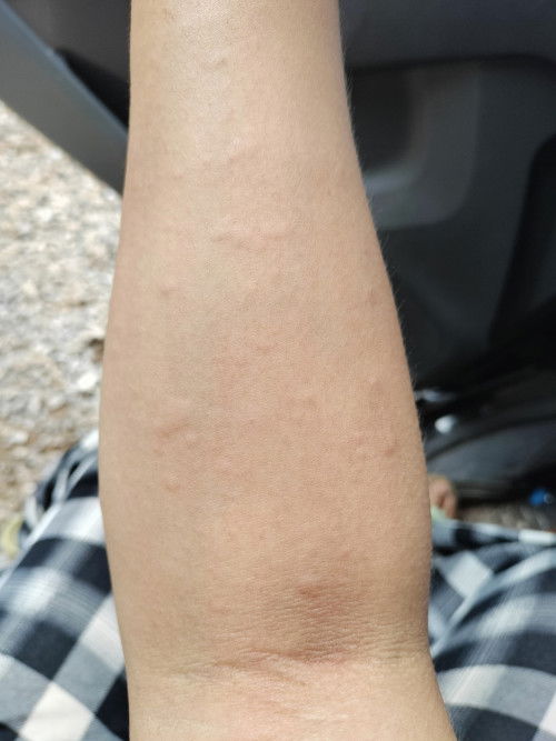 คันตามร่างกาย